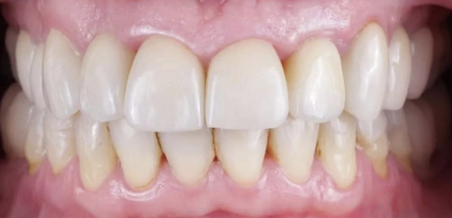 Стан шкіри після процедури №2