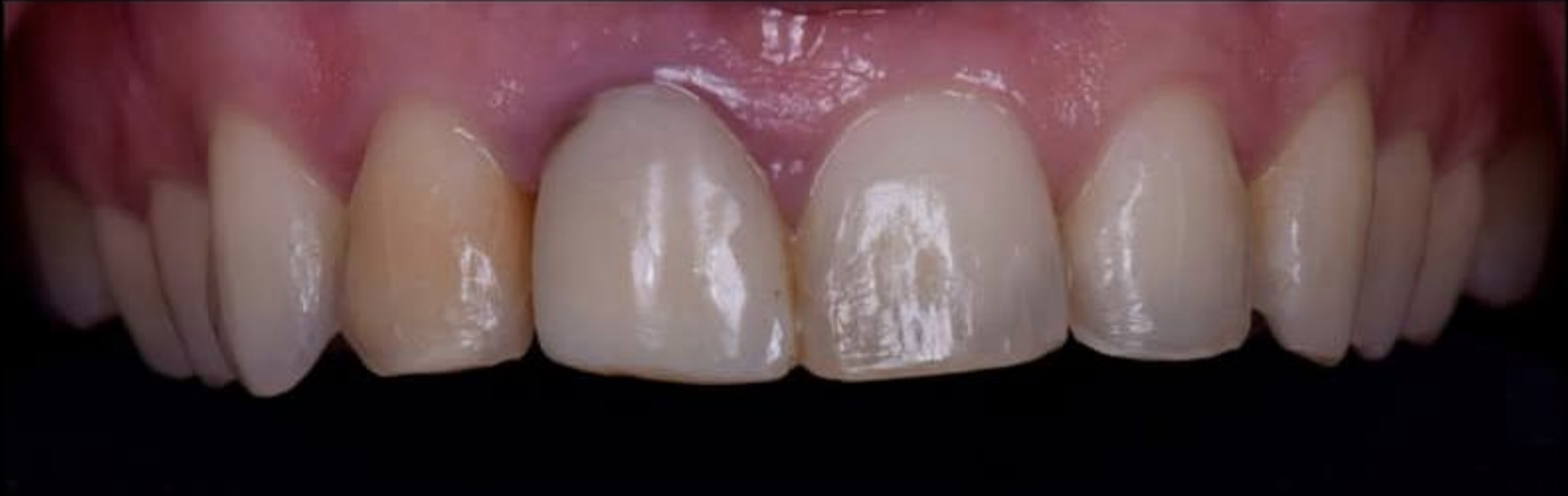 Стан шкіри до процедури №1